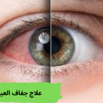 علاج جفاف العين- وطنك
